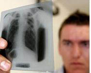 New test could speed tuberculosis results