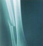 Osteoporosis increases danger of broken bones