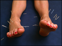 Health: Acupuncture in the UK 健康：针灸在英国