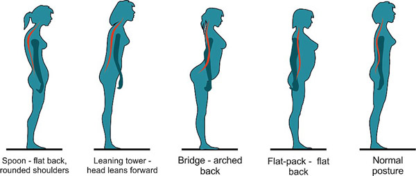 你是“勺形”还是“桥形”？站姿决定背痛与否
