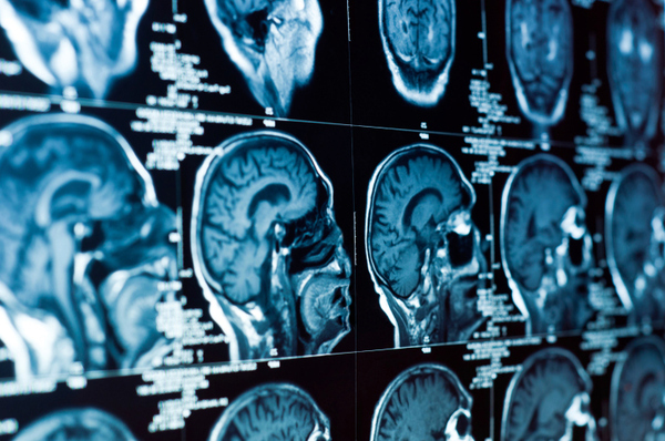 Researchers Seek Ways to Help Damaged Brains Heal