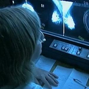 Breast cancer study could change how early growths are treated