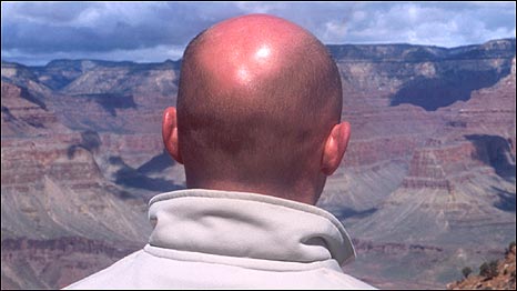 Cause of Baldness 科学家揭晓秃头的原因